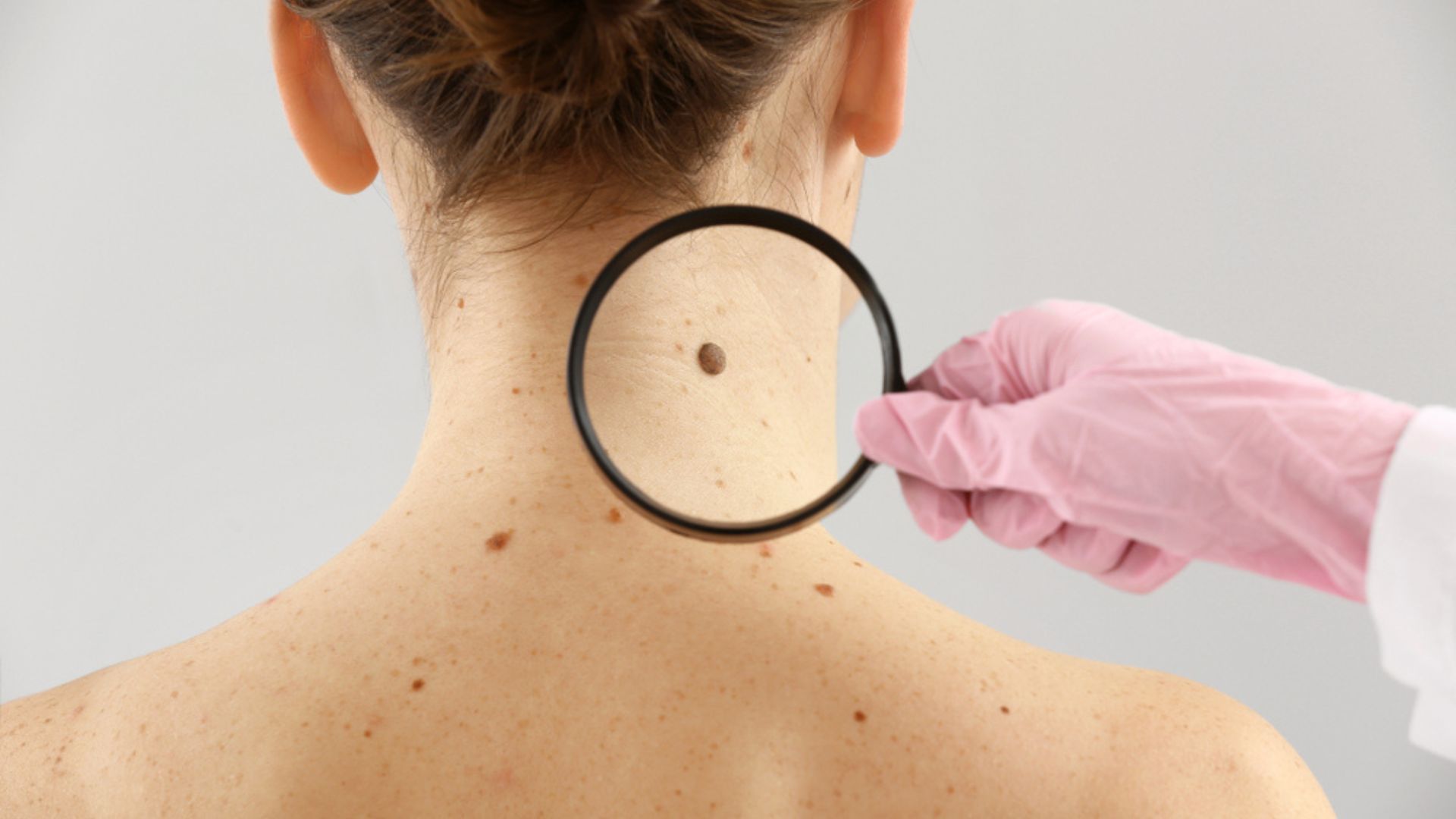 Melanoma