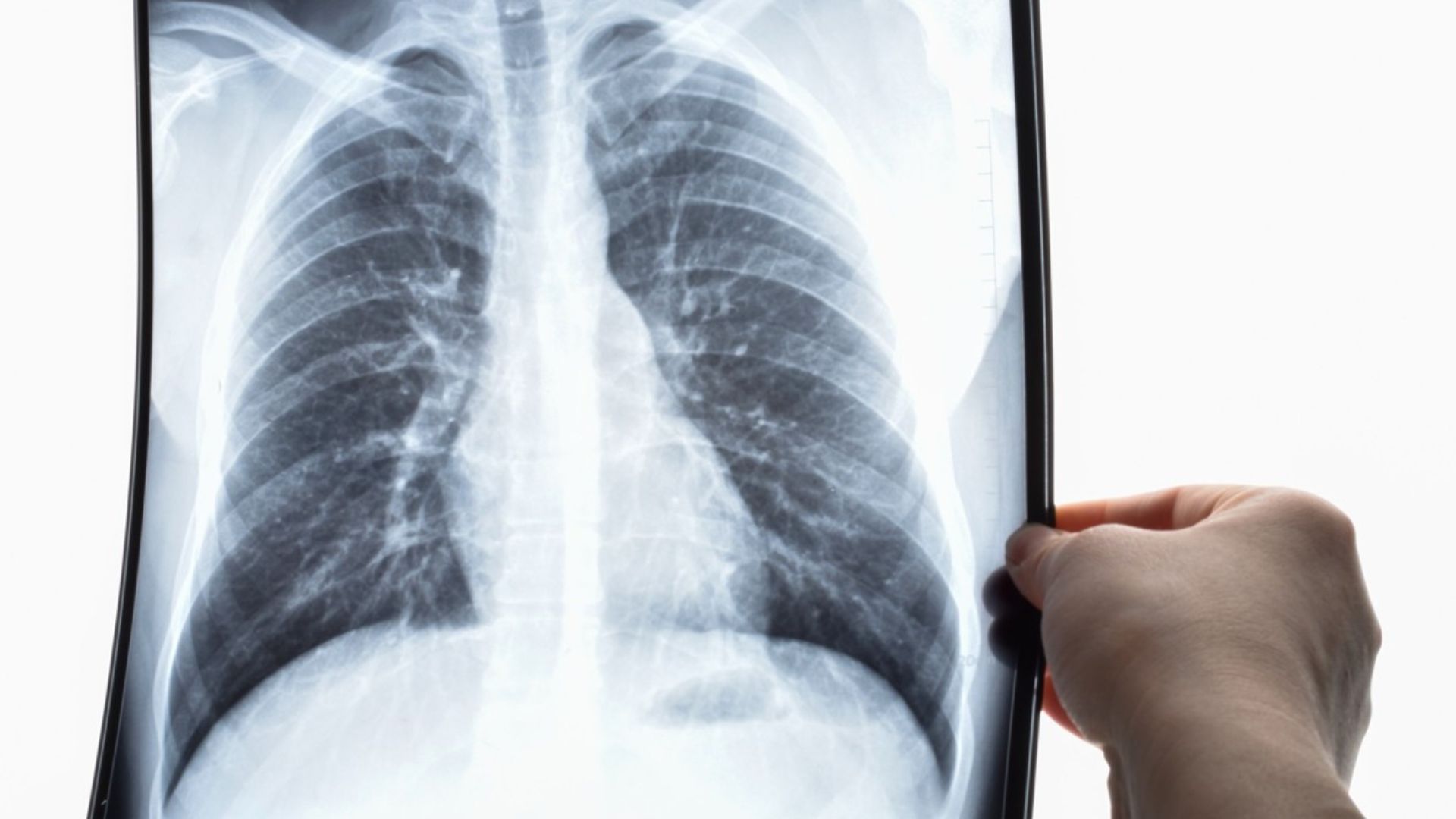 Radiografía de Pulmón